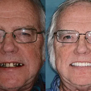 HOOMWELL™ --🦷Advanced Customized Full Denture Set🦷
