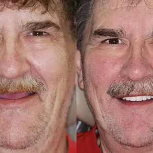 HOOMWELL™ --🦷Advanced Customized Full Denture Set🦷