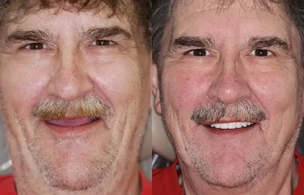 HOOMWELL™ --🦷Advanced Customized Full Denture Set🦷