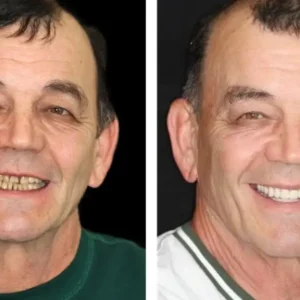 HOOMWELL™ --🦷Advanced Customized Full Denture Set🦷