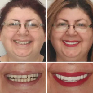 HOOMWELL™ --🦷Advanced Customized Full Denture Set🦷