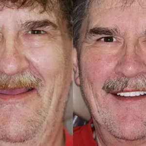 HOOMWELL™ --🦷Advanced Customized Full Denture Set🍎