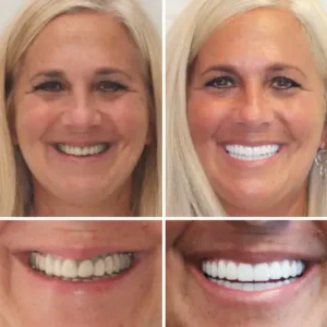 HOOMWELL™ --🦷Advanced Customized Full Denture Set🍎