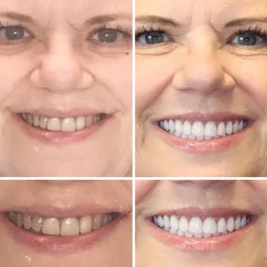 HOOMWELL™ --🦷Advanced Customized Full Denture Set🍎
