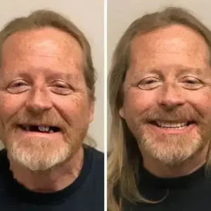 SmileFitPro BioFusion Dentures
