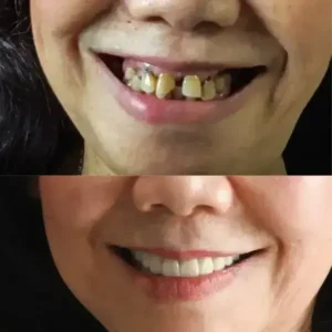SmileFitPro BioFusion Dentures