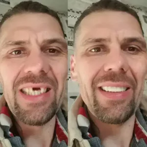 SmileFitPro BioFusion Dentures