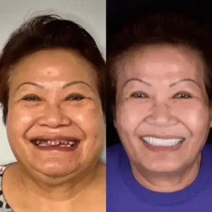 SmileFitPro BioFusion Dentures