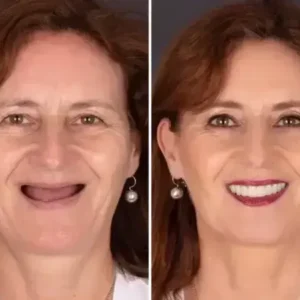 SmileFitPro BioFusion Dentures