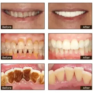 SmileFitPro™ Niacinamide Whitening Toothpaste