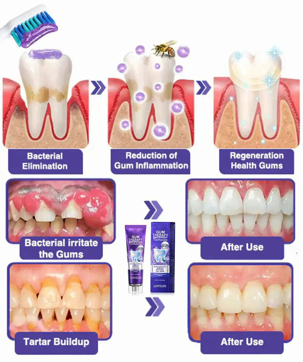 LOVILDS™ Bee Poison Dental Treatment Toothpaste