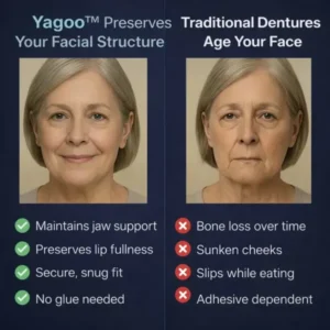 2026🏆✨LAST DAY SALE 60% OFF🔥 Newly upgraded second-generation Yagoo™ complete dentures
