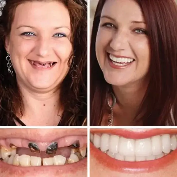 🦷Custom-Fit Dentures | Smile with Confidence