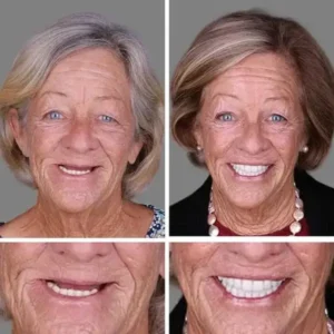 🦷Custom-Fit Dentures | Smile with Confidence