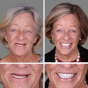 ⏰Ends Today: 70% OFF! 🌎KLENIMORE™ Custom-Fit Dentures— Designed for Comfort and a Natural-Looking Smile