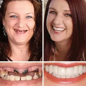 ⏰Ends Today: 70% OFF! 🌎KLENIMORE™ Custom-Fit Dentures— Designed for Comfort and a Natural-Looking Smile