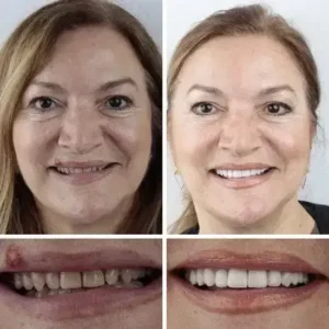 ⏰Ends Today: 70% OFF! 🌎KLENIMORE™ Custom-Fit Dentures— Designed for Comfort and a Natural-Looking Smile