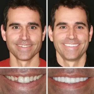 Jakhuors® Premium Denture 2026 | Custom Fit Denture