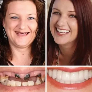 Jakhuors® Premium Denture 2026 | Custom Fit Denture
