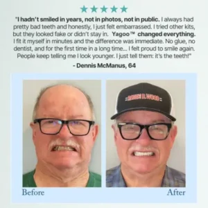Yagoo® 🦷Advanced Customized Full Denture Set🦷 (🔥10,000+ Sold In Last 30 Day)